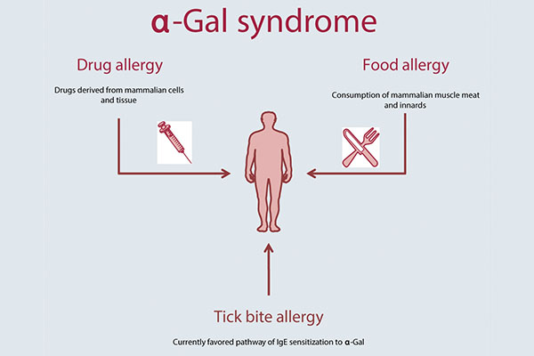 Alfa-galsyndroom: nieuwe mogelijke complicatie bij tekenbeet